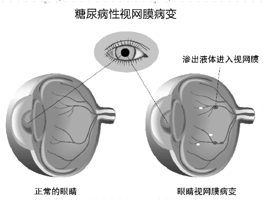 糖友看不清東西？快去查眼底！